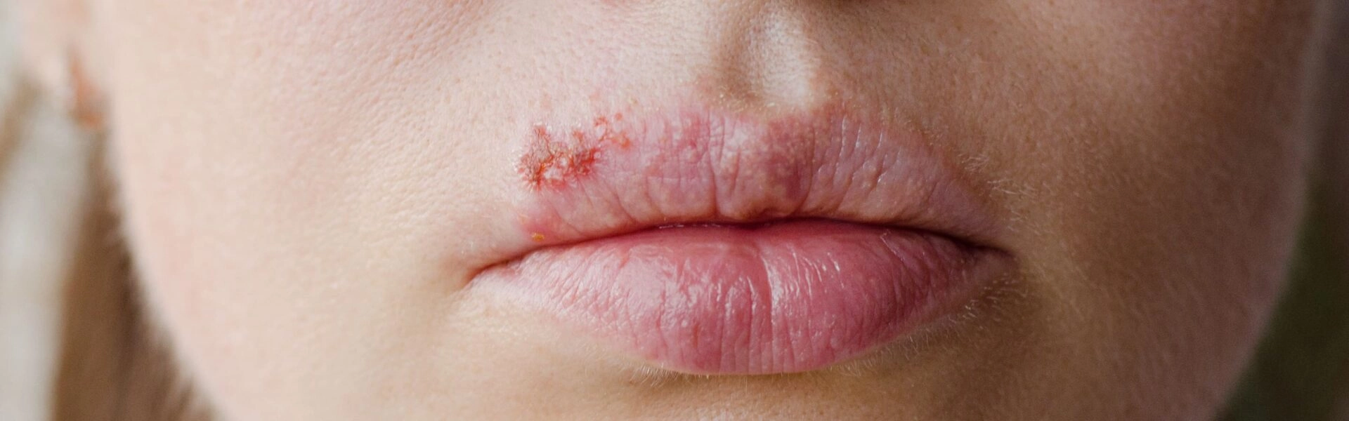 Why do cold sores develop and what should you do?