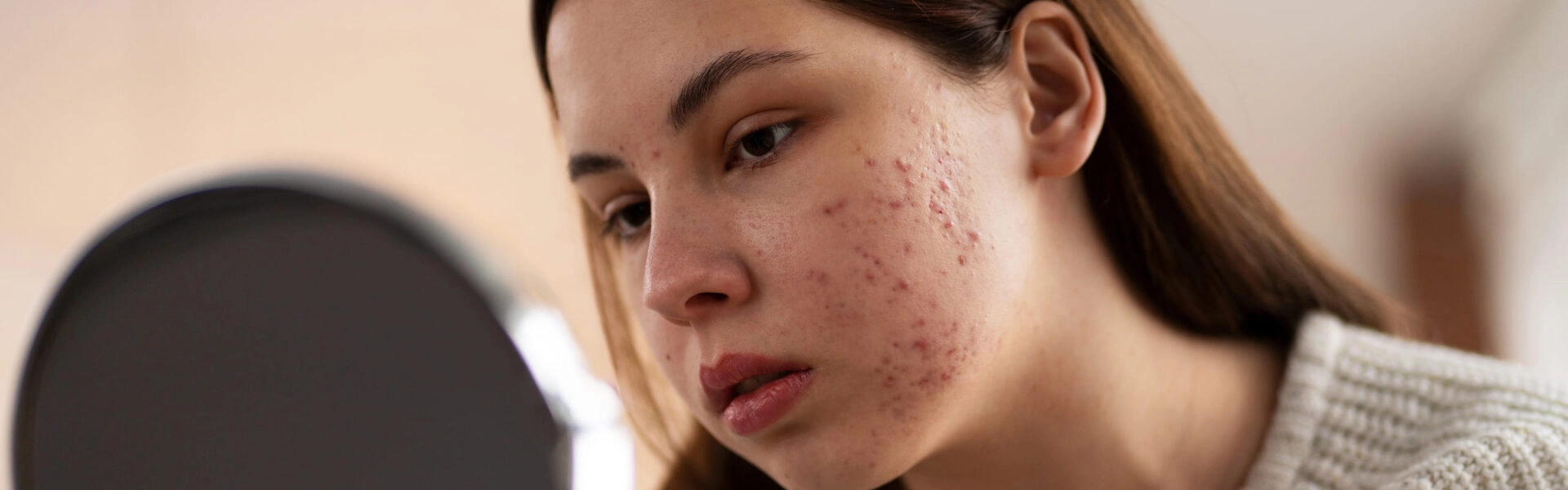 Recognizing acne spots: blackheads, papules, pustules and nodules