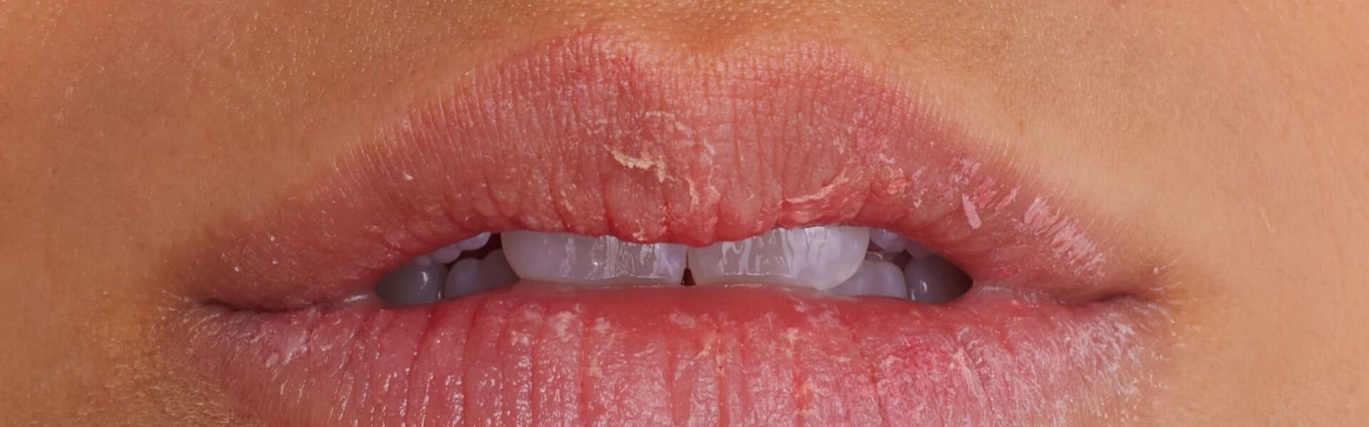 What are the different stages of lip dryness?