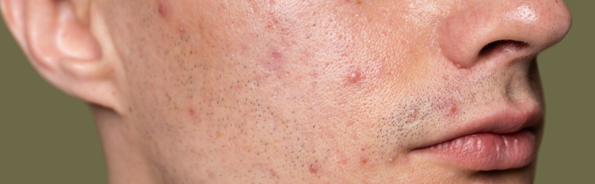 Pimple patches vs Filmogel® Spots: which product should you choose to target facial imperfections?