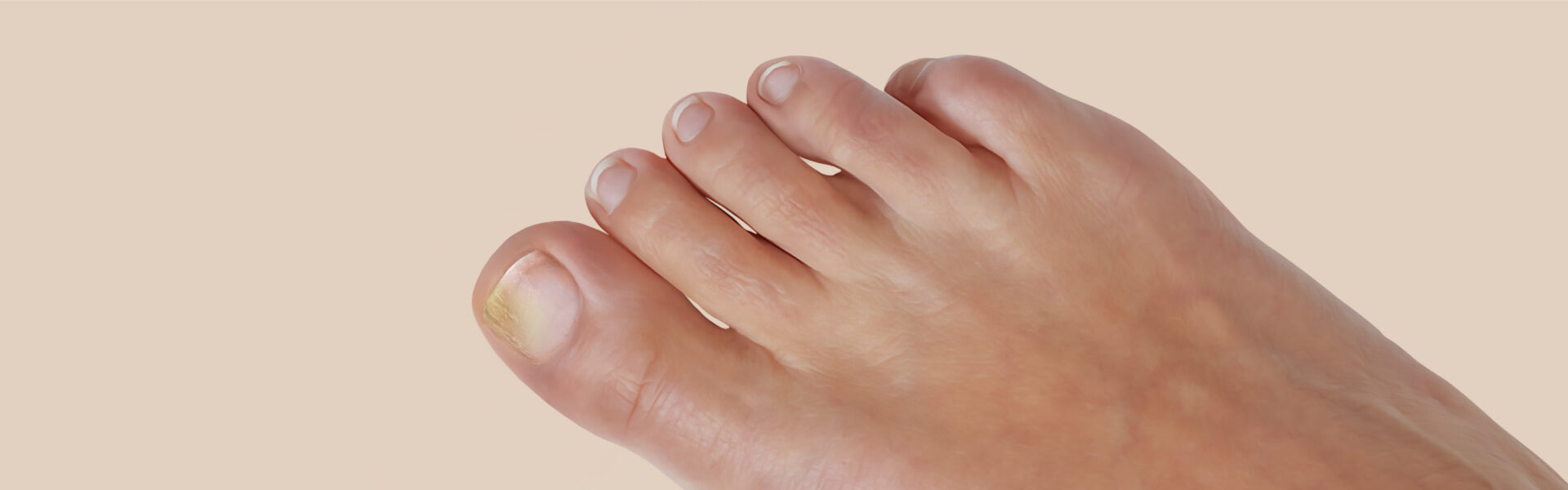 Yellowing toenails