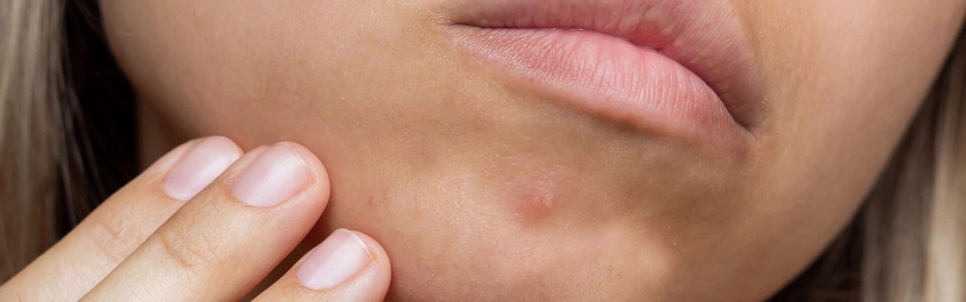 How to get rid of a pimple?