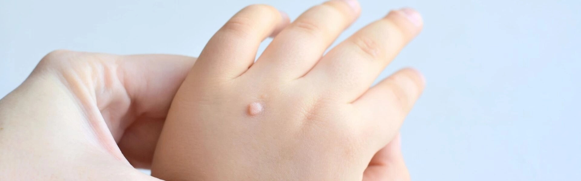 How to recognize, prevent or get rid of a wart?