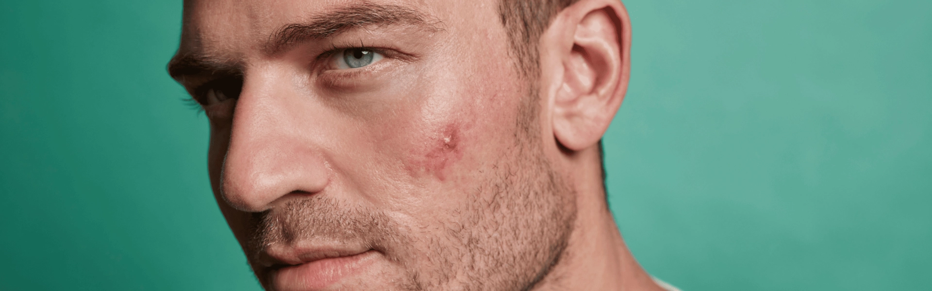 Fighting acne scars on the face: solutions to regain clear skin