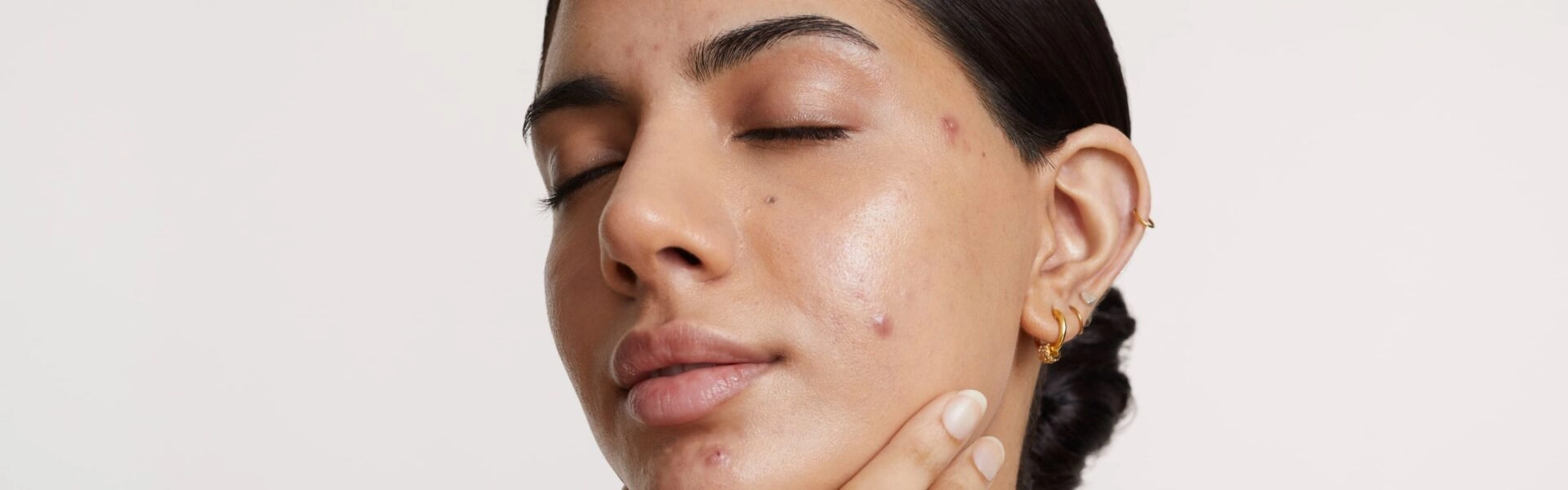 Understanding acne better